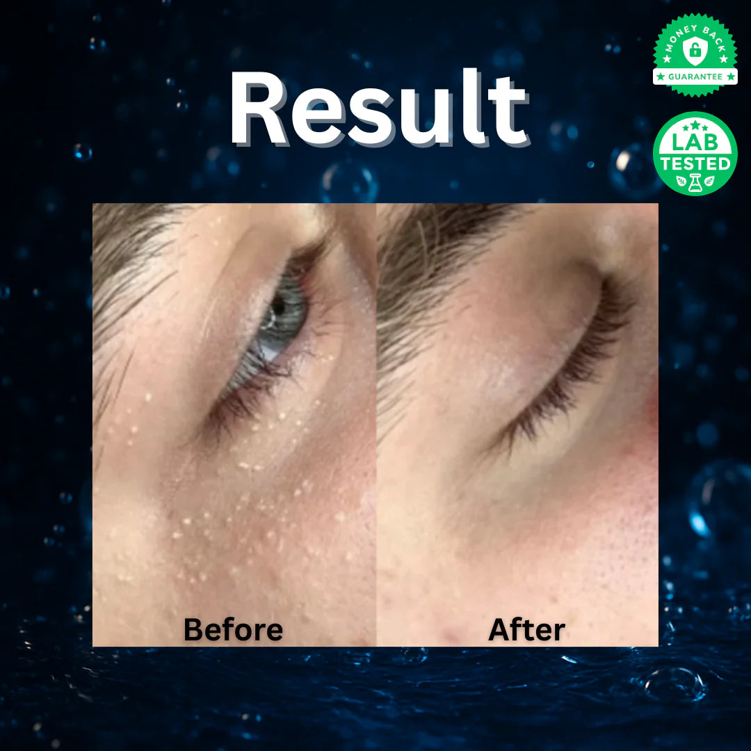 Milia Remover Treatment